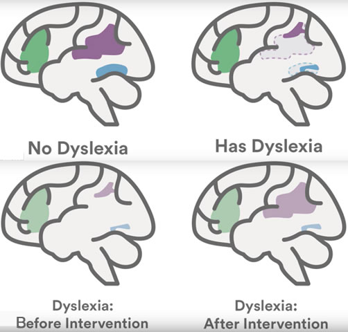 Reading, Dyslexia and Brain Plasticity | | High Performance Learning