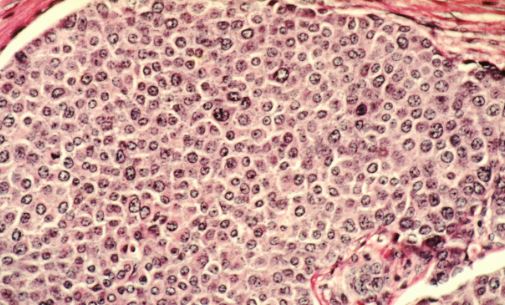 Cancer Cells