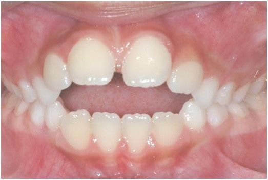 Diastema Due to Abnormal Muscle Diastema Due to Abnormal Muscle