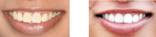 Teeth Whitening Best Teeth Whitening Gurgaon