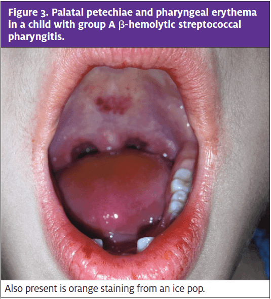 Pediatric Oral Lesions in the Urgent Care Setting Journal of Urgent