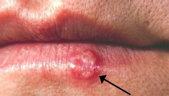 Herpes Sores