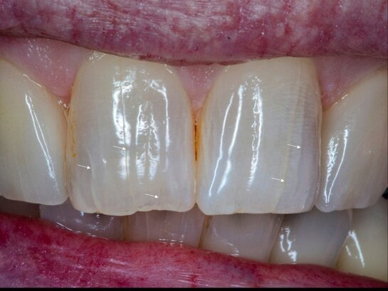 Arrows pointing to craze lines in enamel Enamel cracks or lines on teeth called craze lines