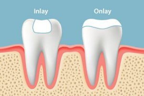 Inlay Onlay prothèse dentaire dentiste paris 16