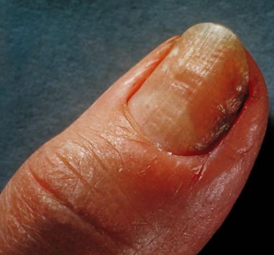 Fungal Nail Infection
