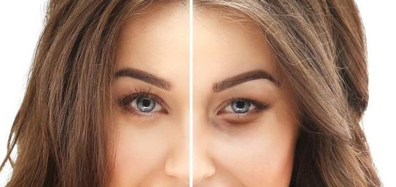 Lidstraffung mit Plasmage