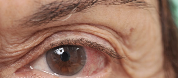 lidhauterschlaffung Dermatochalasis (age-related sagging of the eyelids)