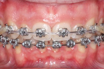 brackets metálicos