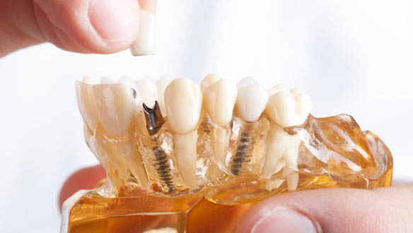 Same Day Dental Implants
