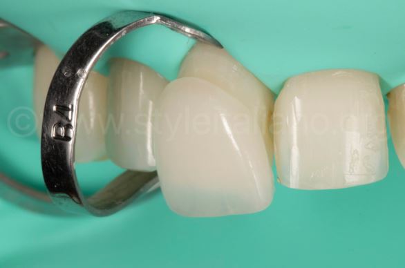 veneer style italiano