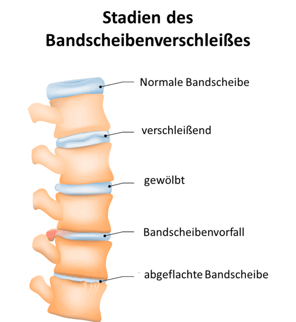 Stadien_Bandscheibenverschleiß Durch Überlastung des Rückens und somit der Bandscheiben findet ein Verschleißprozess statt der bis zu einer Osteochondrose führt.