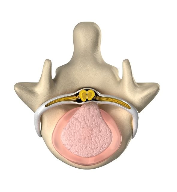 Spinalkanalstenose_Bandscheibenvorfall Durch den Bruch des Faserring tritt Bandscheibenflüssigkeit aus, verengt den Spinalkanal und drückt auf das Rückenmark. Eine Spinalkanalstenose ist das Ergebnis.