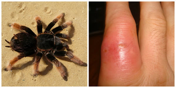Tarantula Bite