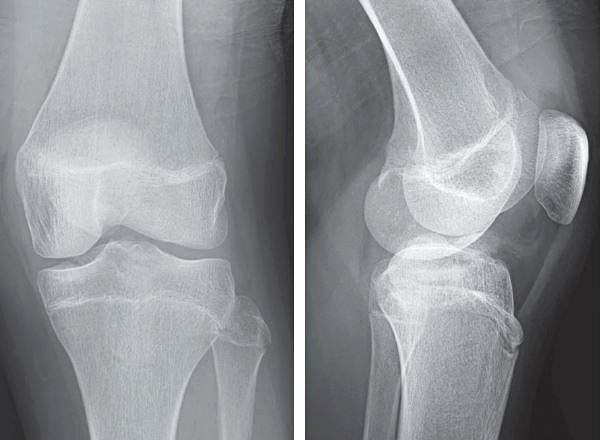 13 year old boy's x-ray image presenting with knee pain after a fall initial image