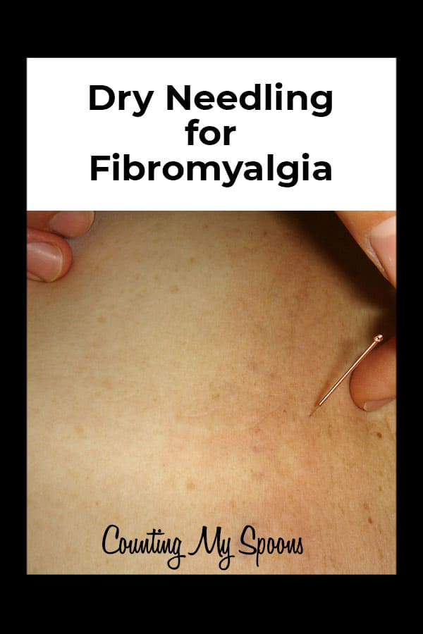 Dry Needling for Fibromyalgia Counting My Spoons