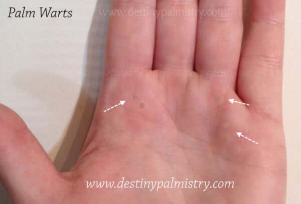 palm warts