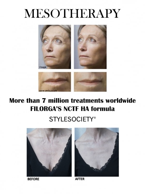 FILORGA Mesotherapy Before and After
