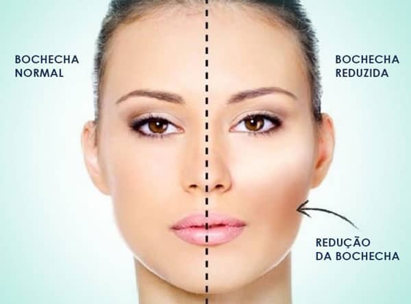 Bichectomia 1 bichectomia clinica adriano abreu odontologia estetica