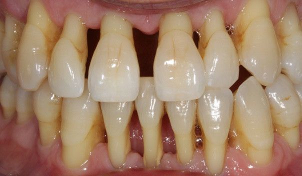 Diastema due to gum disease Diastema due to gum disease