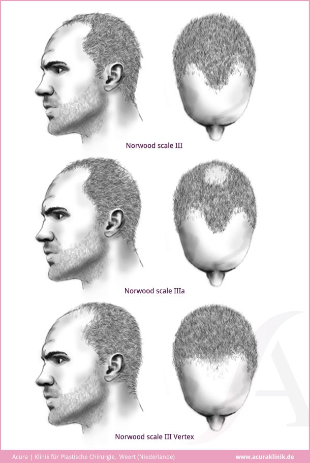 haartransplantation acuraklinik weert