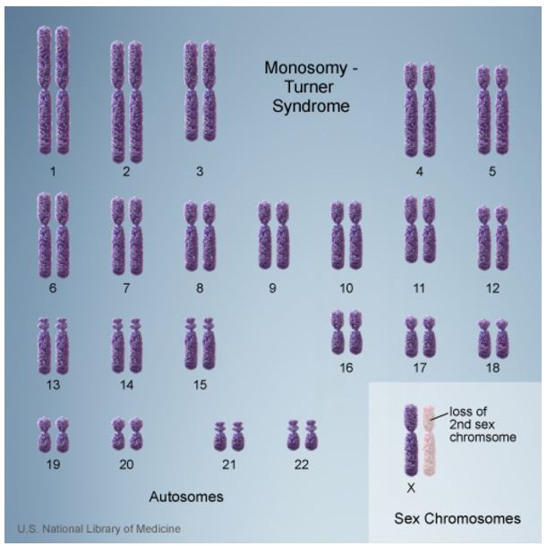 Turner Syndrome