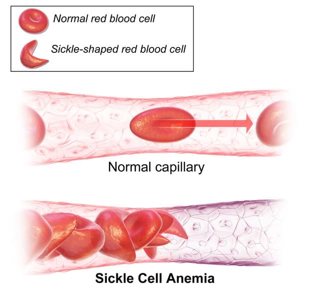 Sickle Cell Anemia