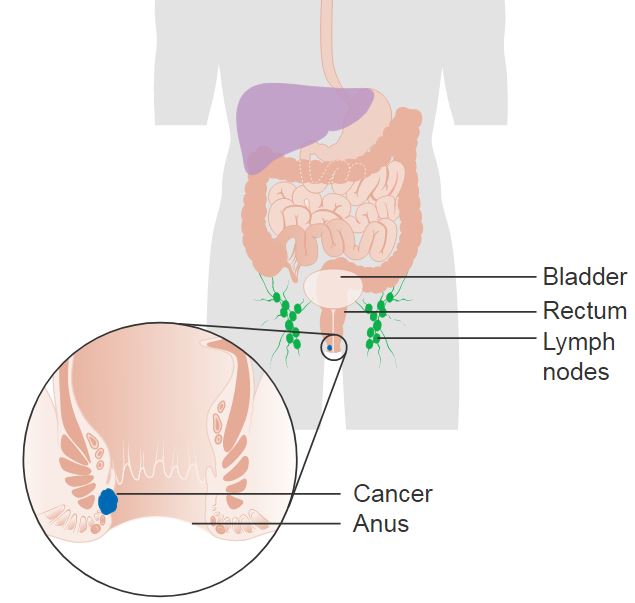 Anal Cancer