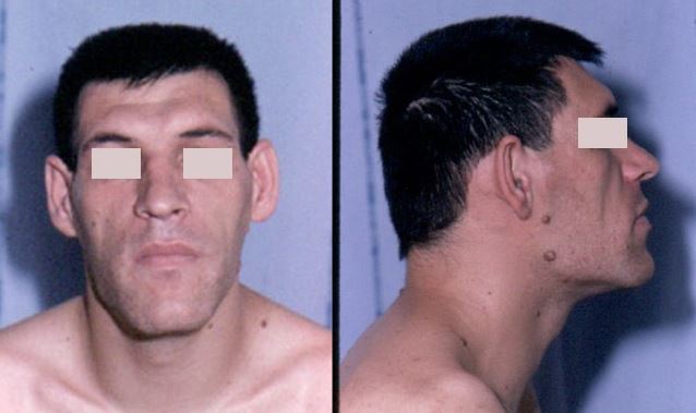 Man With Acromegaly