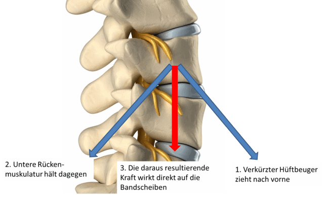 Kräftedreieck Die Kombination aus einem verkürzten Hüftbeuger und einer dagegenhaltenden Rückenmuskulatur führt zu einer verstärkt wirkenden Kraft auf die Bandscheiben. Dies begünstigt einen schnelleren Verschleiß bzw. einem Bandscheibenvorfall.