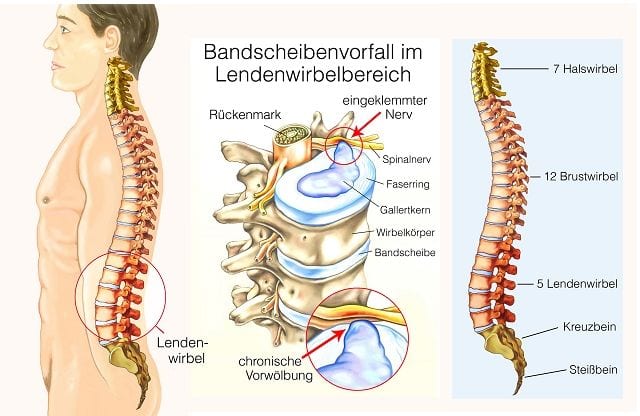 lumbaler Bandscheibenvorfall Ein Bandscheibenvorfall im Lendenwirbelbereich findet zu 98% an den Bandscheiben zwischen Kreuzbein, dem 5. Lendenwirbel sowie dem 4. Lendenwirbel statt. Der Gallertkern wölbt sich vor oder tritt aus durch den Faserring aus. Somit übt er meist Druck auf anliegende Nervenstrukturen aus und führt zu Schmerzen als auch zu neurologischen Ausfallerscheinungen.