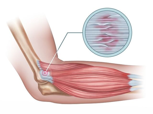 mikrotraumen-tennisarm Die Sehnen sind ebenfalls ein fasziales Gewebe. Durch ständige Überlastung entstehen immer wieder Mikrotaumen. Das führt zu Vernarbungen und Verhärtungen.