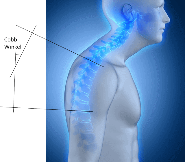 Cobb_Winkel_Kyphose Abhängig vom Cobb-Winkel und des Schmerzzustandes des Patienten wird entschieden wie die Behandlung aussehen soll. Normalerweise ist eine konservative Behandlung wie Physiotherapie oder Korsett ausreichend. In schweren Fällen ist eine Operation erforderlich.