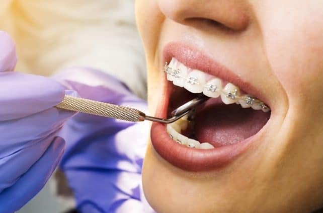 Aparat dentar metalic