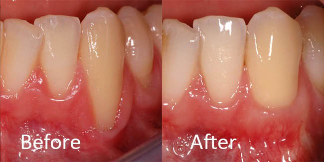 gum graft for gum recession gum recession can be fixed with a gum graft