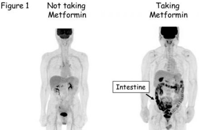 metformin-induced excretion of glucose in the intestine