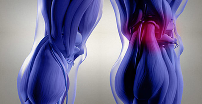 Leg Pain in a 34-Year-Old Man Leg Pain in a 34-Year-Old Man