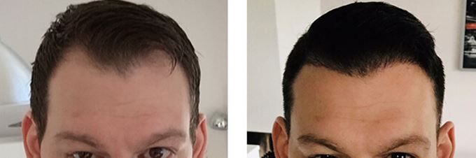 Haartransplantation Angebote und Rabatte.
