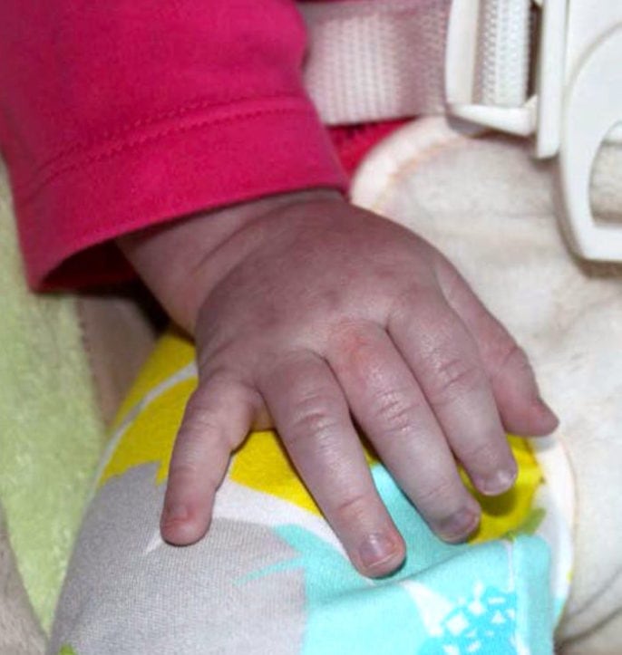 Causas de cianosis
