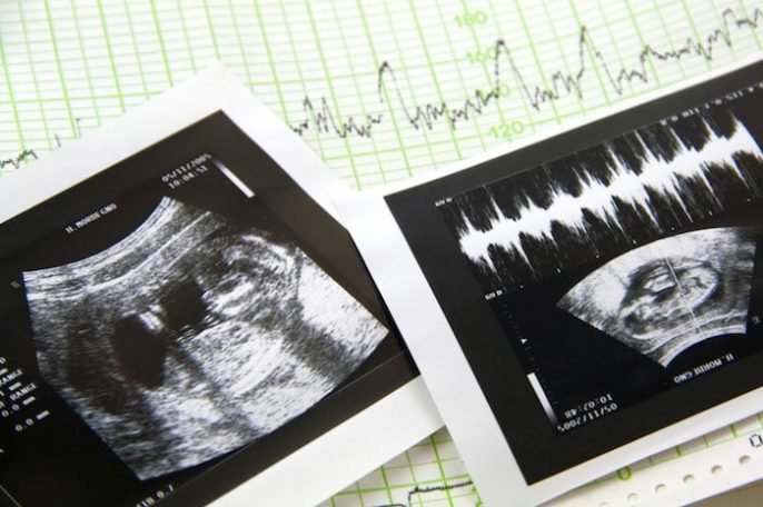 Un nuevo proyecto de ley de Ohio puede, impedir el aborto de su bebé simplemente porque el niño tiene un cromosoma extra