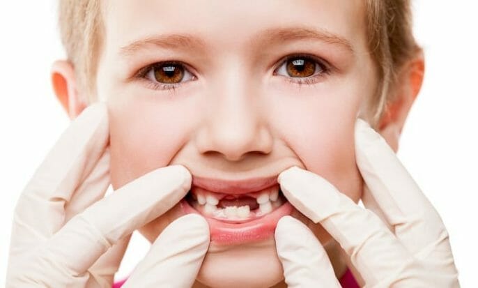 À quoi s'attendre lorsque les dents permanentes de votre enfant arrivent