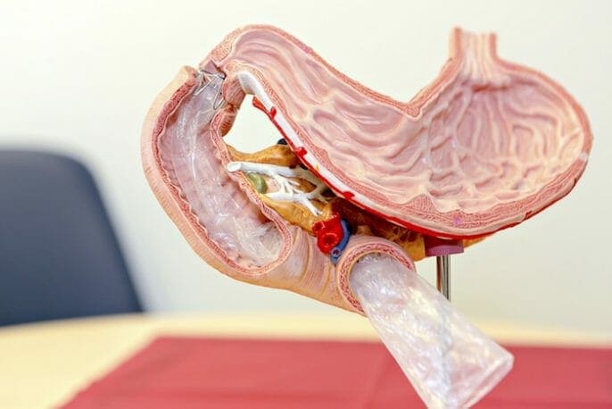 Nueva opción sin cirugía que podría ayudarle a perder peso y vencer a la diabetes tipo 2