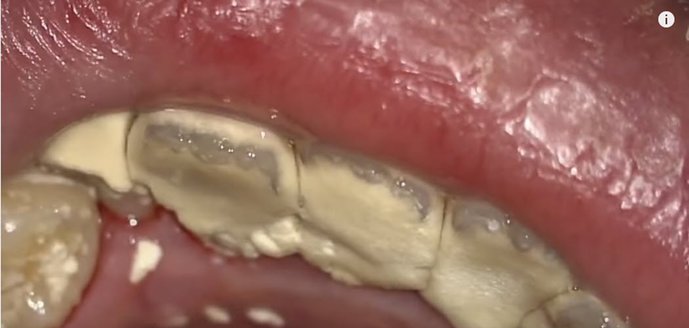 how-to-remove-tartar-and-dental-plaque-from-teeth-naturally-smile-widely