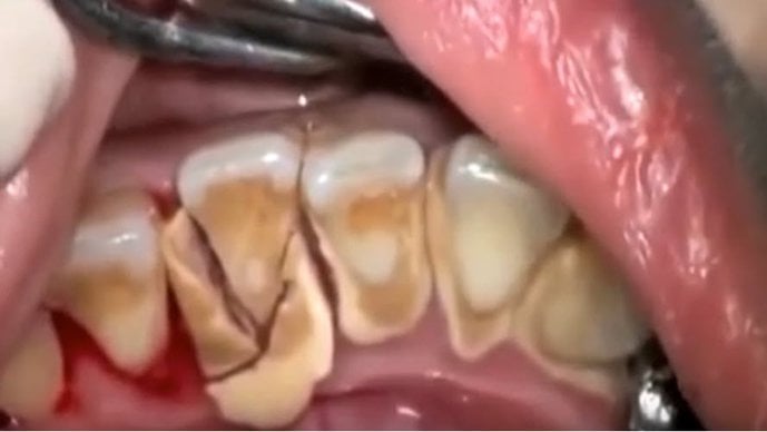 how-to-remove-tartar-and-dental-plaque-from-teeth-naturally-smile-widely