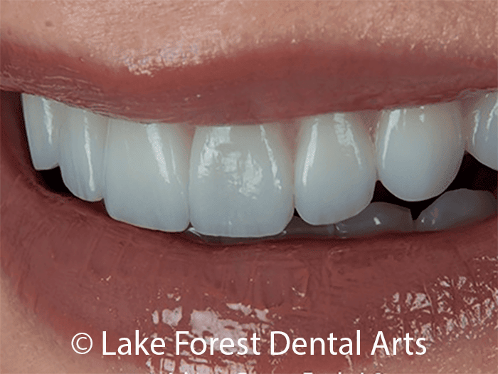 natural looking porcelain veneers Cosmetic tooth coverings