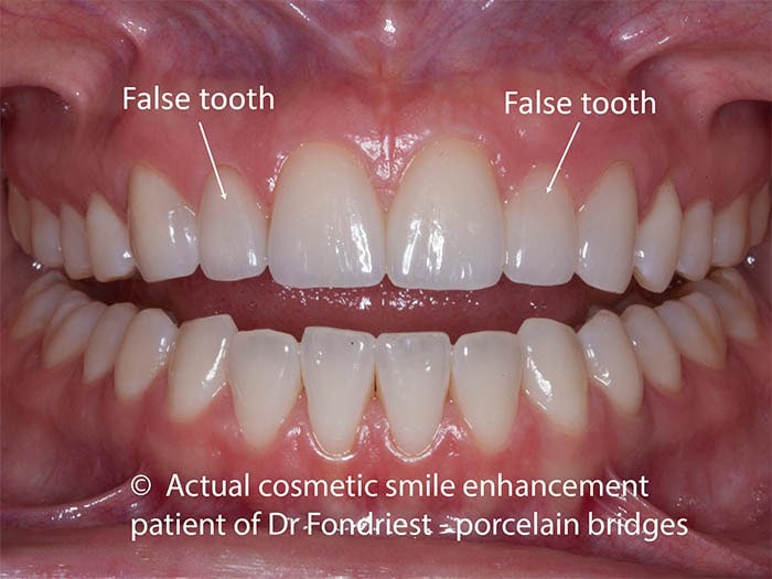 Dental bridges with ovate pontics