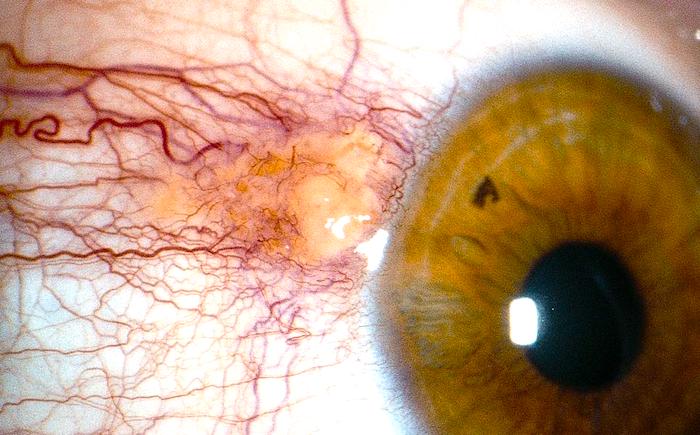 Pinguecula