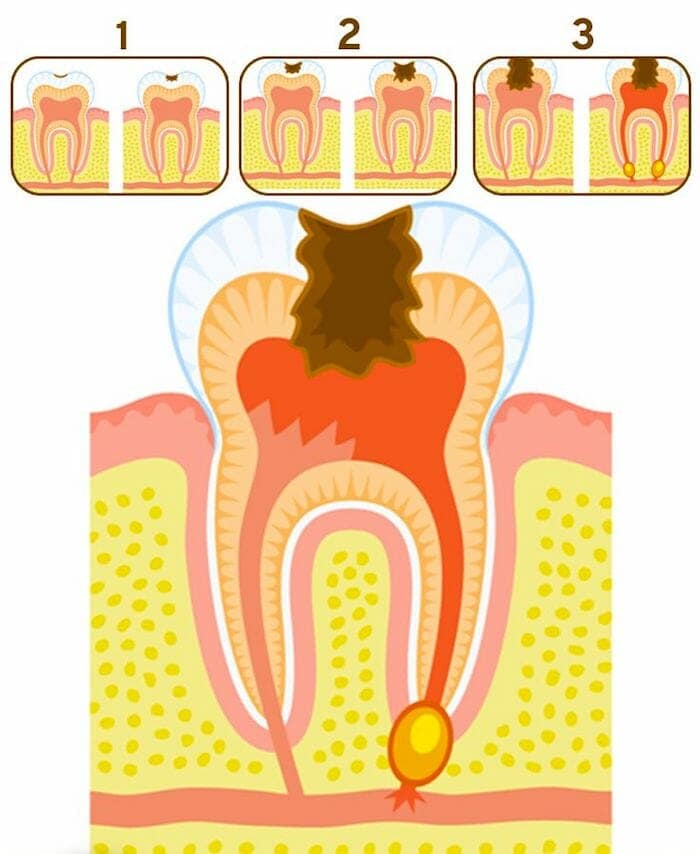 Tratamiento natural para una cavidad "ligera"