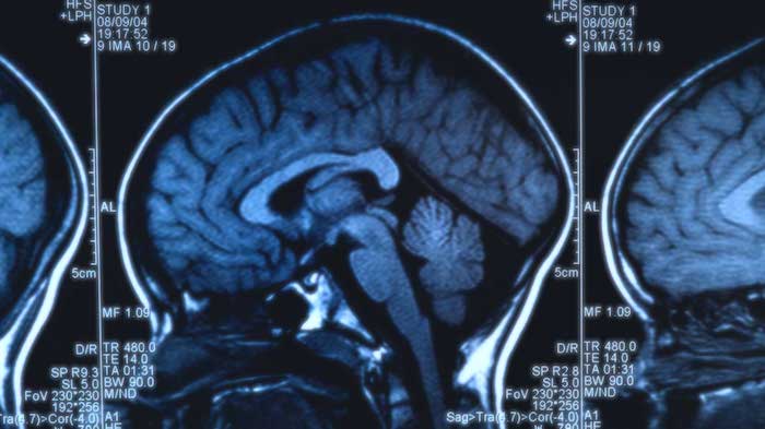 Tumor cerebral pineal: perspectiva do paciente