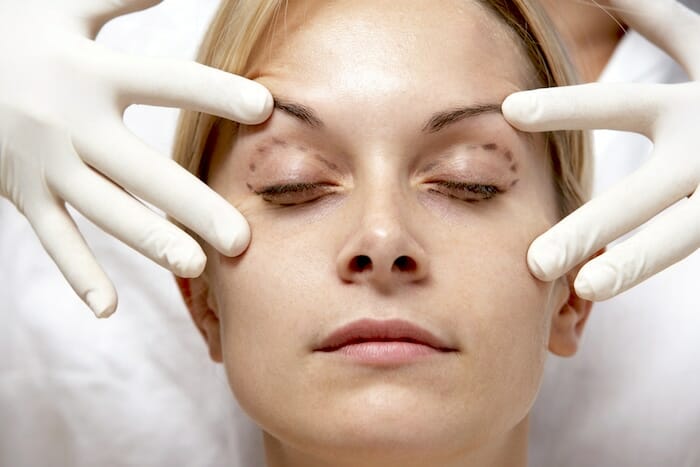 Blefaroplastia o cirugía de párpados: ¿qué esperar?