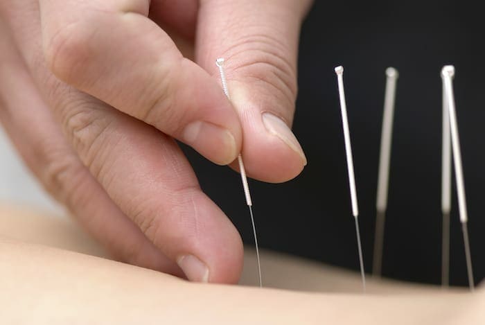 L'acupuncture peut-elle aider à contrôler la douleur?